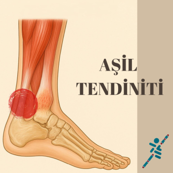 AŞİL TENDİNİTİ