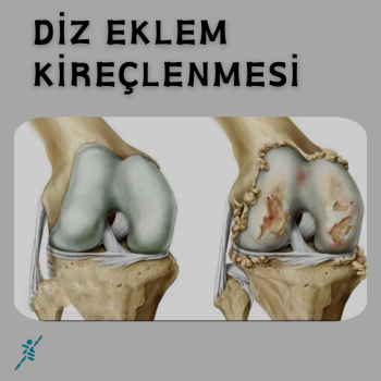 DİZ EKLEM KİREÇLENMESİ