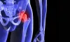 Kalça Eklem Kireçlenmesi Nedir?