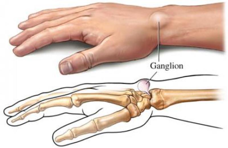 GANGLİON KİSTİ (KİSTİK HİGROMA)